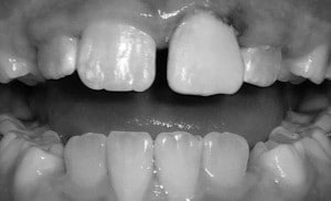 Tooth trauma after image