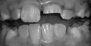 Tooth trauma before image